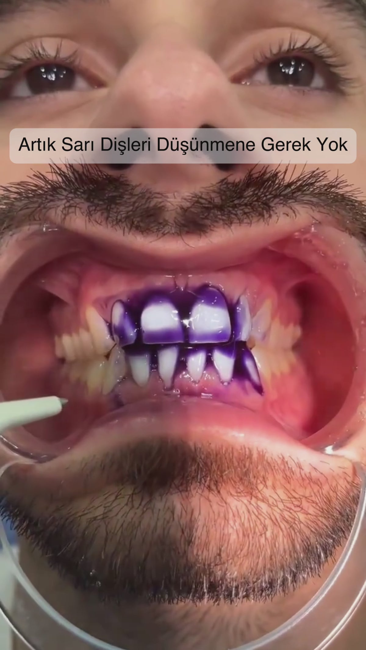 DentaSmile - Anında Beyazlatıcı Diş Macunu